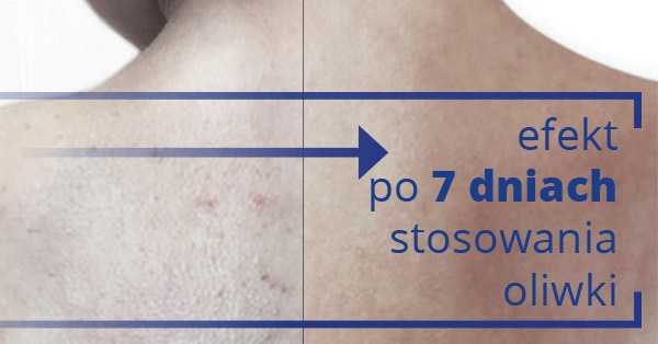 Efekt działania emulsji po 7 dnia stosowania - zdjęcie